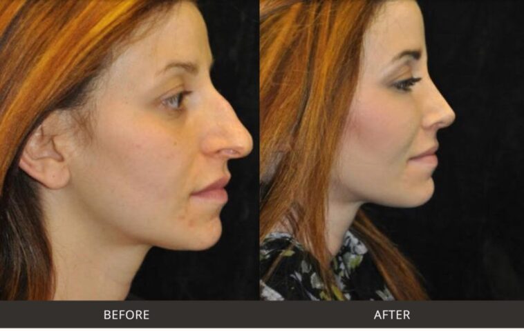 Dr Motykie before after rhinoplasty nose surgery beverly hills 1 1024x648 1