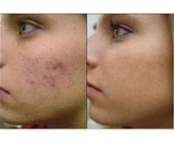 How Do I Choose Between Microneedling and Chemical Peels for Acne Scar