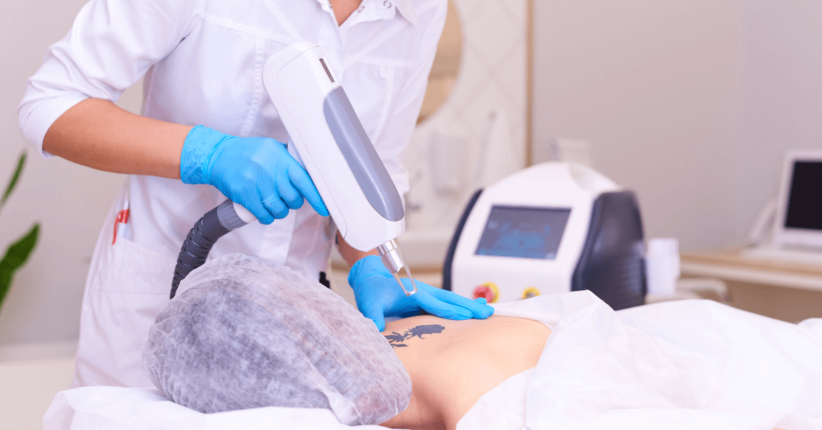 tattoo removal for cover up