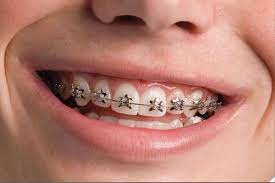 Metal braces are the go to choice for orthodontic treatment