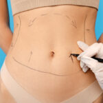 Can Liposuction Help with Stubborn Belly Fat in Dubai
