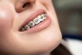 Metal braces are a proven way to align teeth