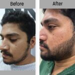 Beard Transplant thumbs 500X500