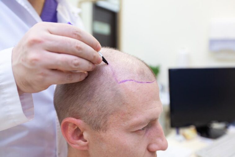 Common Side Effects of Hair Transplants and How to Avoid Them 1 Hair transplant