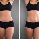 Does Laser Liposuction Permanently Remove Fat or Will It Come Back 21 Does Laser Liposuction Permanently Remove Fat or Will It Come Back