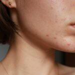 Refresh your complexion fight acne