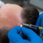 MDFI Hair Transplant thumbs 500X500