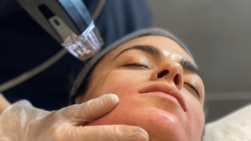 Morpheus8 treatment 1024x683 1