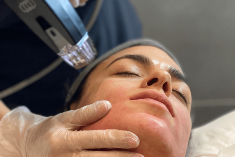 Morpheus8 treatment 1024x683 1