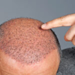 hair transplant in islamabd 1