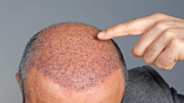 hair transplant in islamabd 1