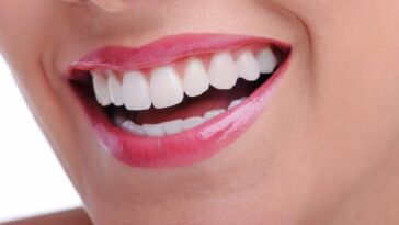 Teeth Whitening Cost in Dubai11