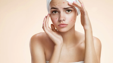 5 Types of Acne Scars How to Treat Them Effectively