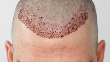 Hair Transplant Recovery OneDay