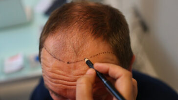 Hair Transplant in Islamabad 2 1
