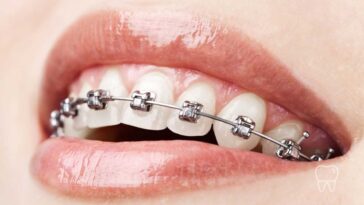 Classic metal braces for a perfect smile
