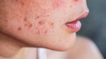 Best Acne Scar Treatment for Every Skin Type
