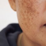 Freckles and Blemishes Treatment in Dubai 8