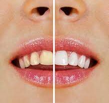 Teeth Whitening Cost in Dubai1