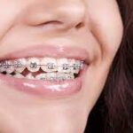 Braces help jaw positioning