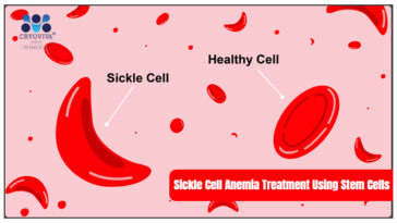 Sickle Cell Anemia Treatment Using Stem Cells