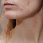 Oxygen Facials for Acne in Dubai 21 ScreenShot20240813at12.35.21pm