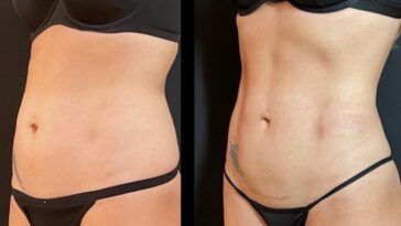 Is a Tummy Tuck in Dubai Safe for People with Previous Surgeries