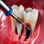 Root Canal vs. Extraction: Which Is Better in Dubai? 21 root3 1