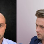 What to Expect During a Hair Replacement Consultation? 20 manhairsystembeforeafter05d08ad63cb74e9ebde9b9f854dd3ed6