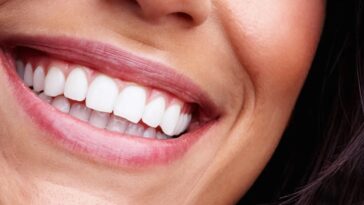 Full Mouth Dental Implants Cost in Dubai