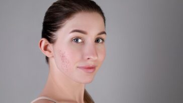 Acne Scar Treatment in Dubai 13