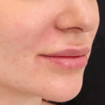 Can Nefertiti Lift Treat Marionette Lines