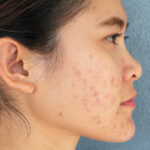 How Dubai Dermatologists Treat Teen Acne 22 Askinserviceheroacne