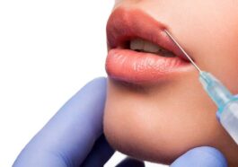 Lip Filler