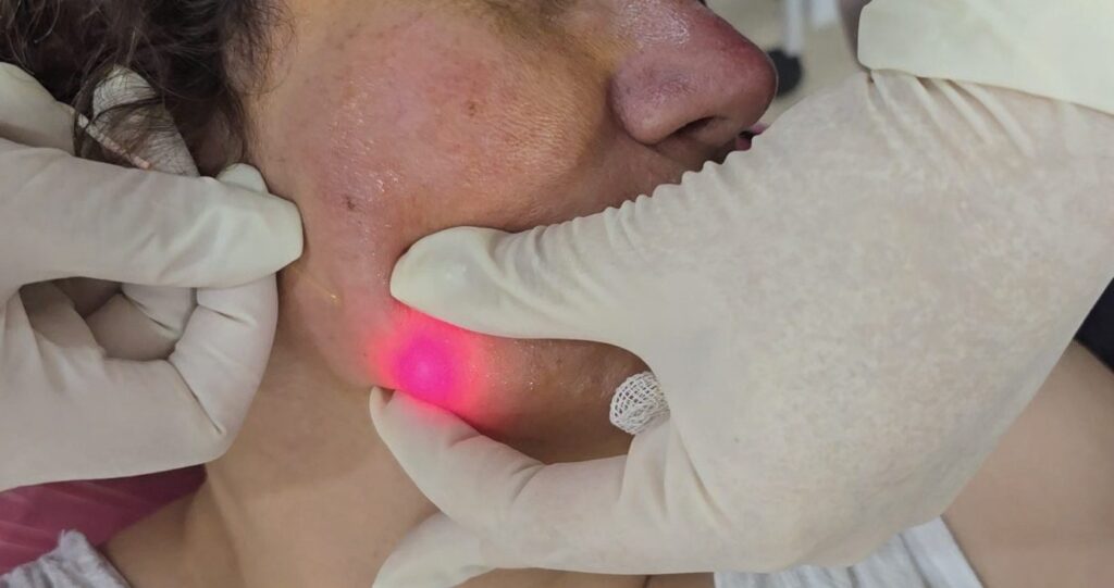 Is Endolift a Painful Procedure? 2 Endolift Reviews e1730851855184