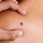 How Do Mole Removal Treatments Affect Skin? 21 laser hair removal mole removal 10