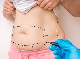 Is a Tummy Tuck in Dubai Safe for People with Previous Surgeries 1