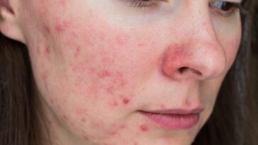 How to Remove Acne Scars Effectively