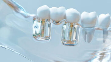 dental implants 2