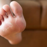 How to Maximize Botox for Foot Sweating Results? 21 sweaty feet