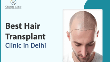 best hair transplant clinic in delhi