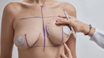 Is a Breast Lift the Right Solution for Drooping Breast