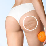 celulitida 450x253 1