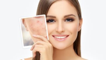 How Effective is Micro needling for Treating Acne Scars in Dubai