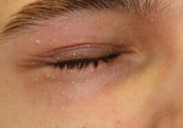 Professional milia removal for smoother skin