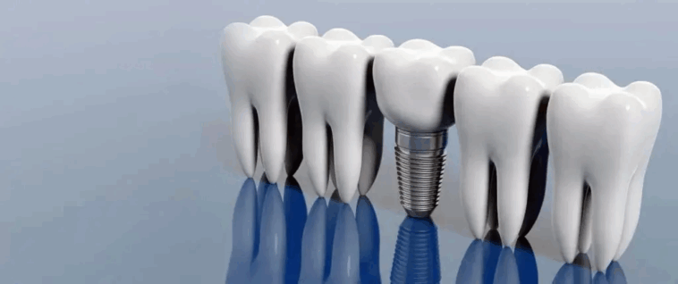 Why More People Are Choosing Dental Implants in Dubai 1 implant slider.jpg kopiya 1024x430.jpg