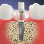 Dental Implants Give You a Permanent and Beautiful Smile Solution 21 DentalImplants1200