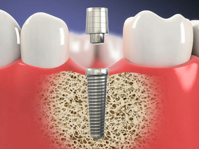 DentalImplants1200