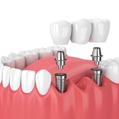 Cost of Dental Implant in Islamabad Pakistan.jpg