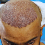Hair Transplant in Dubai Is the Move for Modern Grooming 22 Hair Follicle Surgery A Complete Guide to Hair Restoration 1024x576 1